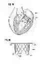 Fig. 16 - Prosthetic valve for replacing mitral valve