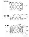 Fig. 19 - Prosthetic valve for replacing mitral valve