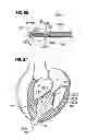 Fig. 25 - Prosthetic valve for replacing mitral valve
