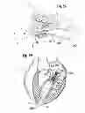 Fig. 26 - Prosthetic valve for replacing mitral valve