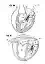 Fig. 30 - Prosthetic valve for replacing mitral valve