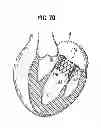 Fig. 32 - Prosthetic valve for replacing mitral valve