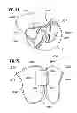 Fig. 33 - Prosthetic valve for replacing mitral valve