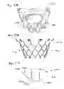 Fig. 67 - Prosthetic valve for replacing mitral valve
