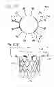 Fig. 68 - Prosthetic valve for replacing mitral valve