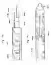 Fig. 74 - Prosthetic valve for replacing mitral valve