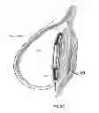 Fig. 09 - Methods and systems for breast reconstruction