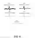 Fig. 06 - Electrocardiogram baseline removal