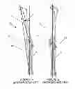 Fig. 02 - Systems and methods for determining the mechanical axis of a femur