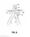 Fig. 09 - Method of making a conduit for interventional procedures