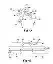 Fig. 02 - Endovascular staple clip and stapler
