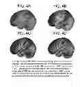 Fig. 05 - Variable-depth stereotactic surface projections