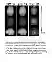 Fig. 06 - Variable-depth stereotactic surface projections