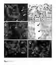 Fig. 02 - Somatic mutations in ATRX in brain cancer