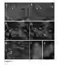 Fig. 03 - Somatic mutations in ATRX in brain cancer