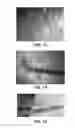 Fig. 08 - ACCOMMODATING INTRAOCULAR LENS