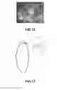 Fig. 09 - ACCOMMODATING INTRAOCULAR LENS