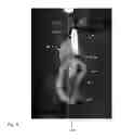 Fig. 09 - Surgical guide kit apparatus and method