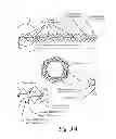 Fig. 04 - GASTRIC ELECTROMAGNETIC BAND CONTROLLED BY AUTOMATIC EATING DETECTION