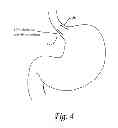 Fig. 07 - GASTRIC ELECTROMAGNETIC BAND CONTROLLED BY AUTOMATIC EATING DETECTION