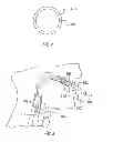 Fig. 03 - Laryngeal Mask Assembly