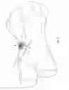 Fig. 06 - SURGICAL IMPLANT GUIDE SYSTEM AND METHOD
