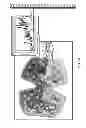 Fig. 32 - CRYOTHERAPY DEVICES AND METHODS TO LIMIT ISCHEMIC INJURY SIDE EFFECTS