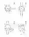 Fig. 04 - Hip Orthosis, Method for Preventing the Dislocation of a Hip and Use of a Hip Orthosis