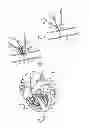 Fig. 03 - Left Atrial Appendage Shunt
