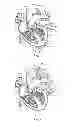 Fig. 04 - Left Atrial Appendage Shunt