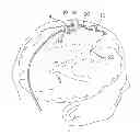 Fig. 01 - Multi-lumen ventricular drainage catheter