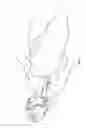 Fig. 09 - Split-tip catheter including lateral distal openings