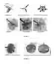 Fig. 19 - Delivery system for in situ forming foams and methods of using the same