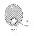 Fig. 09 - Eccentric balloon laser catheter