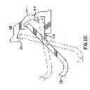 Fig. 49 - Apparatus and method for compressing body tissue