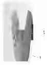 Fig. 06 - SURGICAL DEVICE WITH INTEGRATED VISUALIZATION AND CAUTERIZATION
