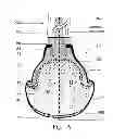 Fig. 02 - Shock absorbing implantable limb prosthetic