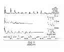 Fig. 08 - Selective recruitment and activation of fiber types in nerves for the control of undesirable brain state changes