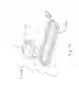 Fig. 136 - Obstructive sleep apnea treatment devices, systems and methods