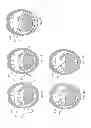 Fig. 147 - Obstructive sleep apnea treatment devices, systems and methods