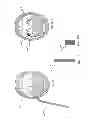 Fig. 149 - Obstructive sleep apnea treatment devices, systems and methods