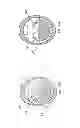 Fig. 152 - Obstructive sleep apnea treatment devices, systems and methods