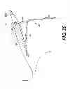 Fig. 30 - Obstructive sleep apnea treatment devices, systems and methods