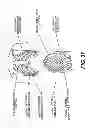 Fig. 50 - Obstructive sleep apnea treatment devices, systems and methods