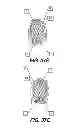 Fig. 52 - Obstructive sleep apnea treatment devices, systems and methods