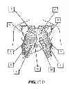 Fig. 53 - Obstructive sleep apnea treatment devices, systems and methods