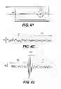 Fig. 59 - Obstructive sleep apnea treatment devices, systems and methods
