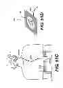 Fig. 71 - Obstructive sleep apnea treatment devices, systems and methods