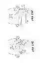 Fig. 72 - Obstructive sleep apnea treatment devices, systems and methods