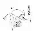 Fig. 75 - Obstructive sleep apnea treatment devices, systems and methods